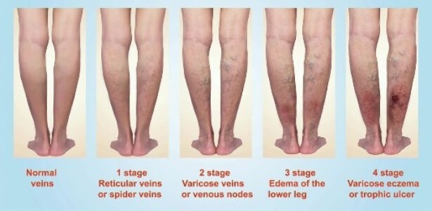 4 stages of Varicose Veins